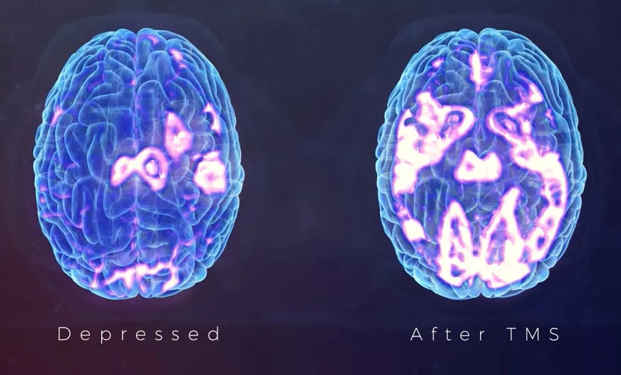 depressed brain vs tms treatment brain