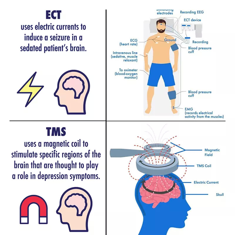 ect vs tms therapy