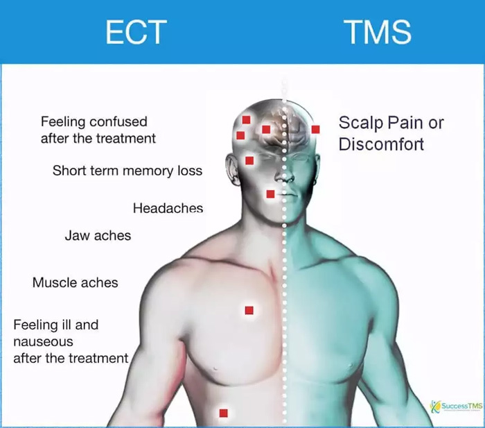 ect vs tms treatment comparison