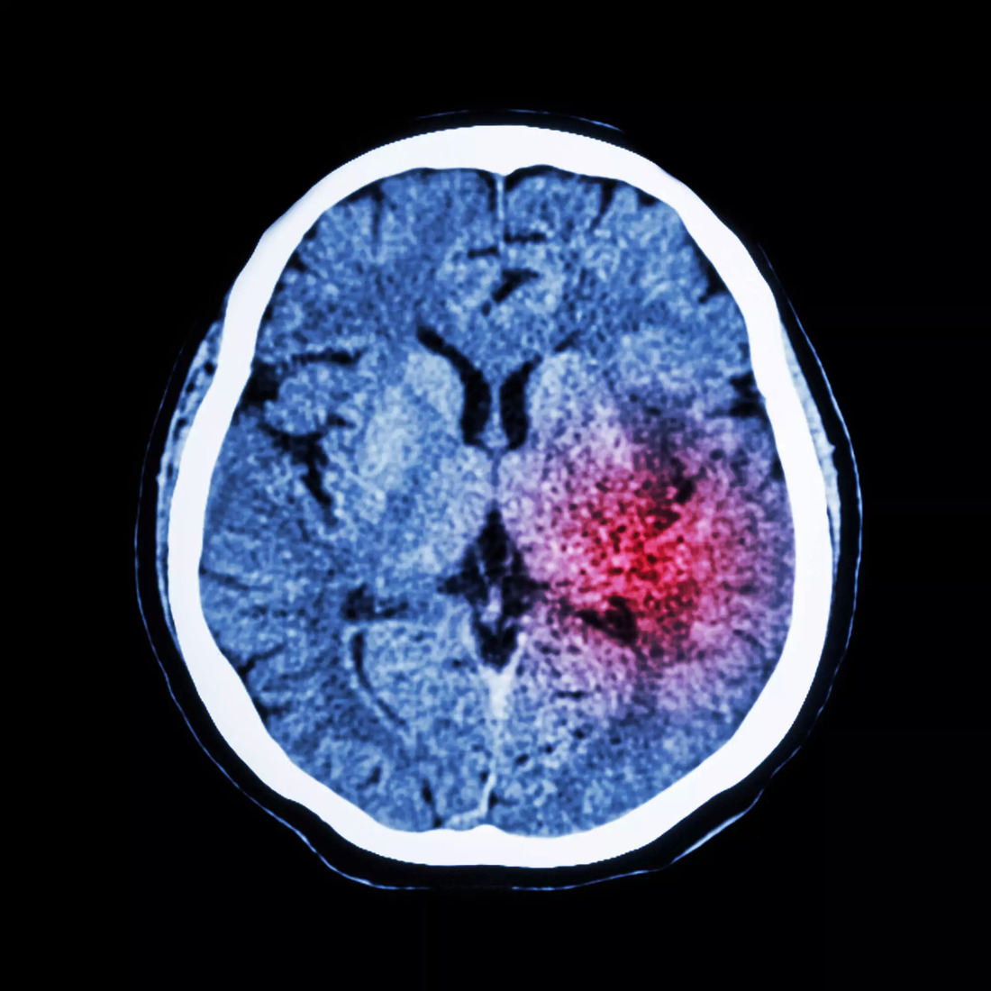 tms for Stroke Rehabilitation illustration